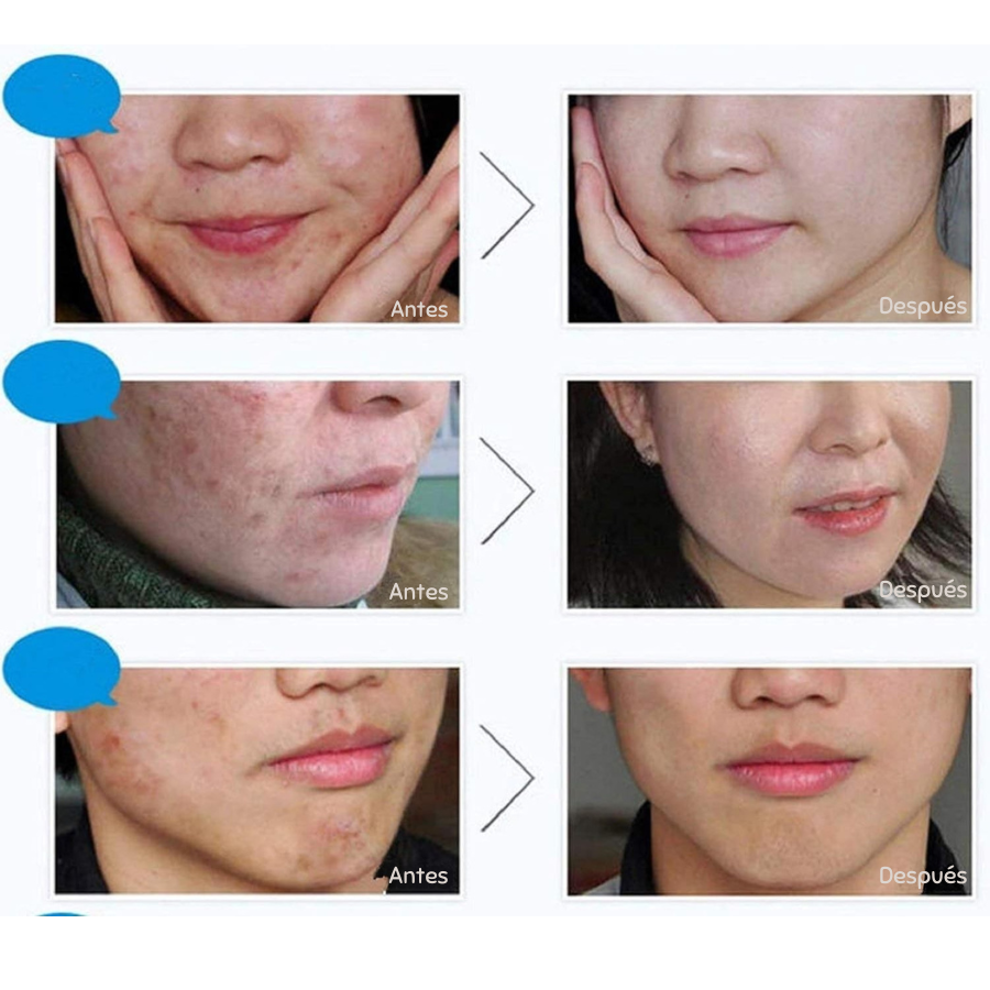 Combo Anti Acne Bioaqua de 4 pasos