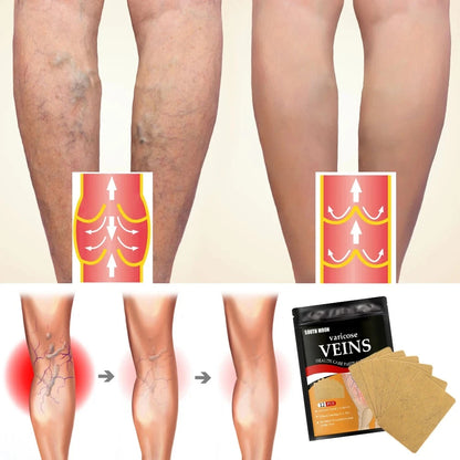 Parches Anti Varices - 24 parches + ¡12 de REGALO!